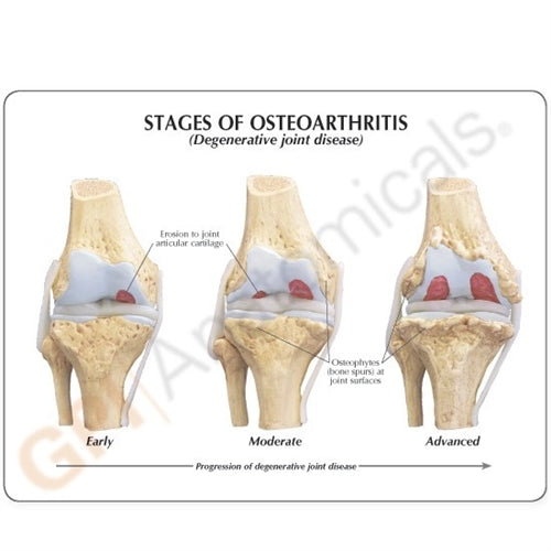 4 Stage Osteoarthritis Knee Anatomical Model | HMGDIRECT Australia ...