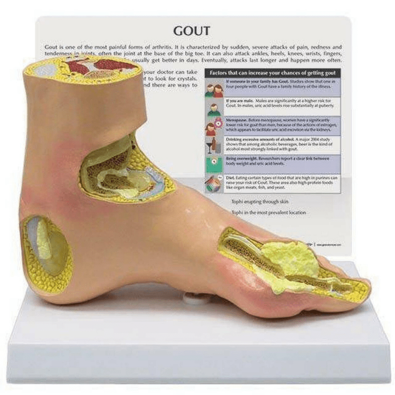 Gout hot sale in heel